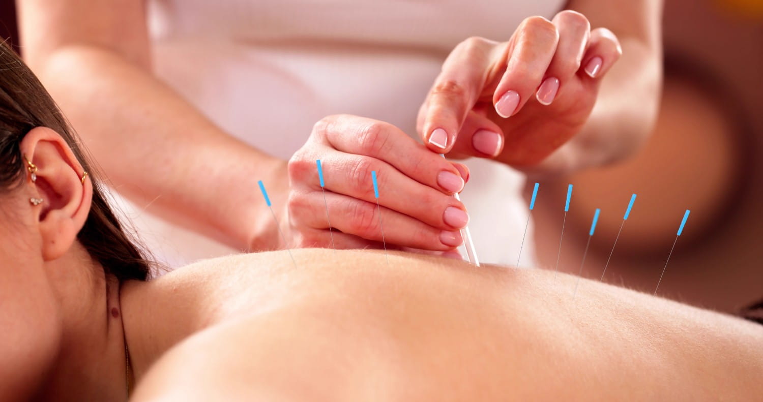 Acupuncture as part of a root-cause care plan at True Health