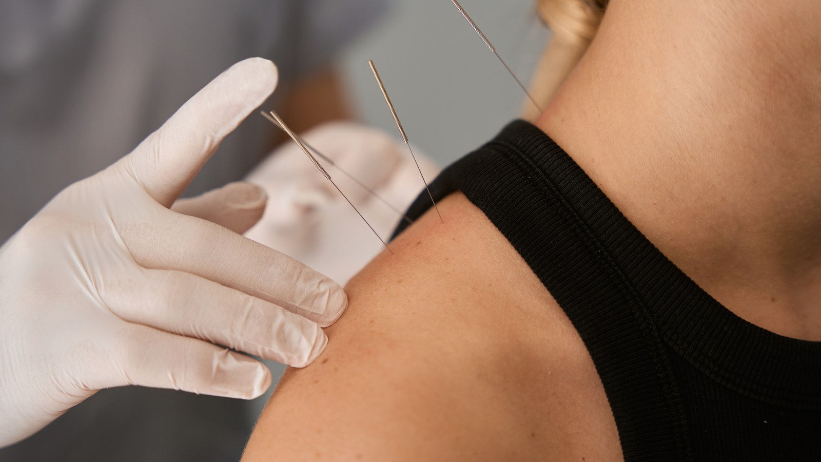 Dry needling vs acupuncture at True Health in Lombard — provider placing thin needles in a patient's shoulder